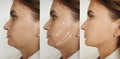 Woman double chin removal tightening plastic saggy before and after treatment aesthetic Royalty Free Stock Photo