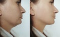 Woman double chin removal   before and after treatment aesthetic Royalty Free Stock Photo