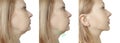 Woman double chin sagging problem before and after procedure treatment Royalty Free Stock Photo