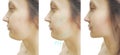 Woman double chin before and after  aesthetic treatment Royalty Free Stock Photo