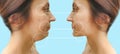 Woman double chin  facelift procedure   before and after  contour  problem difference regeneration treatment concept Royalty Free Stock Photo