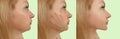 Woman double chin before after treatment correction facelift saggy