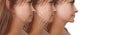 Woman double chin procedure concept   before and after treatment collagen Royalty Free Stock Photo