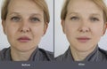 Woman double chin before and after  removal  treatment saggy Royalty Free Stock Photo