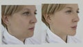 Woman double chin before and after rejuvenation  treatment saggy Royalty Free Stock Photo