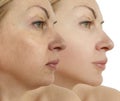 Woman double chin before after aesthetic facelift procedure treatment rejuvenation Royalty Free Stock Photo