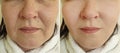 Woman double chin before and after collage oval facelift effect treatment sagging problem Royalty Free Stock Photo