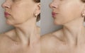 Woman double chin before after treatment removal Royalty Free Stock Photo