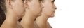 Woman double chin lifting medical before and after result sagging treatment Royalty Free Stock Photo