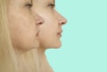 Woman double chin before and after treatment  difference  thread Royalty Free Stock Photo