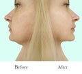 Woman double chin before and after treatment thread Royalty Free Stock Photo