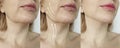 Woman double chin before and after treatment correction Royalty Free Stock Photo