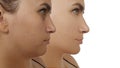 Woman double china esthetic correction before after treatment facelift Royalty Free Stock Photo