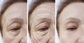 Woman elderly face skin wrinkles contrast before and after procedures, arrow Royalty Free Stock Photo