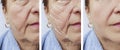 Woman elderly face skin wrinkles correction contrast before and after procedures, arrow Royalty Free Stock Photo