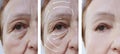 Woman elderly face skin wrinkles hydrating cosmetology rejuvenation before and after procedures, arrow