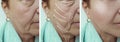 Woman elderly face wrinkles correction regeneration mature contrast before and after procedures, arrow