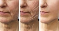 Woman elderly facial wrinkles lifting filler therapy cosmetology regeneration before and after procedures arrow Royalty Free Stock Photo