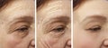 Woman elderly facial wrinkles correction cosmetology regeneration before and after procedures arrow Royalty Free Stock Photo