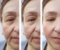 Woman elderly facial wrinkles lifting medicine therapy cosmetology regeneration before and after procedures arrow Royalty Free Stock Photo