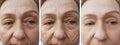 Woman elderly facial wrinkles lifting medicine correction therapy cosmetology regeneration before and after procedures arrow Royalty Free Stock Photo