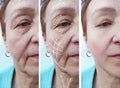 Woman elderly facial wrinkles correction regeneration before and after procedures arrow Royalty Free Stock Photo