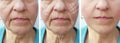 Woman elderly facial wrinkles correction before and after procedures arrow Royalty Free Stock Photo