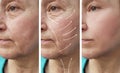 Woman elderly facial wrinkles correction therapy cosmetology regeneration before and after procedures arrow Royalty Free Stock Photo
