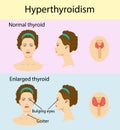 Woman with enlarged hyperthyroid gland. Vector illustration. Royalty Free Stock Photo