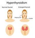Woman with enlarged hyperthyroid gland. Vector illustration. Royalty Free Stock Photo