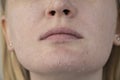 A woman examines dry skin on her face. Peeling, coarsening, discomfort, skin sensitivity. Patient at the appointment of a