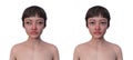 A woman with exotropia and a healthy person, 3D illustration