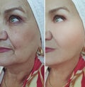 woman eye removal sagging wrinkles regeneration before after treatment therapy collagen tightening mature plastic result