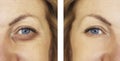 Woman, eye swollen before and after procedures, treatm Royalty Free Stock Photo