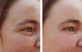 Woman eye wrinkles before and after cosmetic procedures