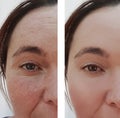 Woman eye wrinkles before and after dermatology cosmetic hydrating procedures