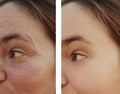 Woman eye wrinkles before and after dermatology cosmetic procedures Royalty Free Stock Photo