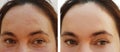 Woman eye wrinkles before and after dermatology effect retouch cosmetic hydrating procedures Royalty Free Stock Photo