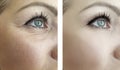 Woman eye wrinkles before and after procedures