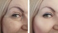 Woman eye wrinkles before and after procedures biorevitalization