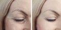 Woman eye wrinkles before and after treatment procedures biorevitalization