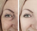 Woman eye wrinkles before and after bloating treatment procedures biorevitalization