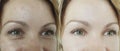 Woman eyes removal wrinkles before and after regeneration therapy antiaging difference results revitalization treatment