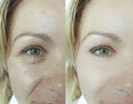 Woman eyes removal wrinkles before and after therapy antiaging difference results revitalization treatment