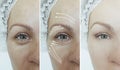 Woman eyes wrinkles before after collage treatment arrow blepharoplasty