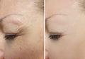 Woman eyes wrinkles correction revitalization collage treatment before and after treatment effect Royalty Free Stock Photo