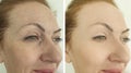 Woman eyes wrinkles before and after dermatology treatment regeneration Royalty Free Stock Photo