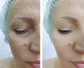 Woman eyes wrinkles before and after difference beautician mature correction treatment plastic blepharoplasty Royalty Free Stock Photo