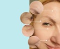 Woman eyes wrinkles lifting  correction    effect before and after difference treatment Royalty Free Stock Photo