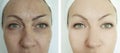 Woman eyes wrinkles puffiness  before and after  beautician treatment Royalty Free Stock Photo